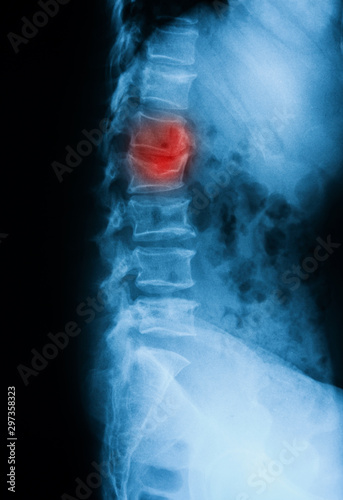 Thoracolumbar spine (T-L spine) X-ray, lateral view, showing spinal compression fracture or vertebral bursh fracture  at L4 (4th Lumbar Vertebra) photo