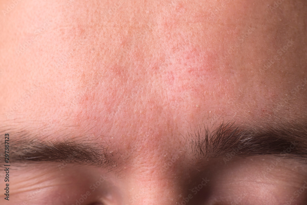 weeping eczema in the stage of exudation. Closeup of forehead area with