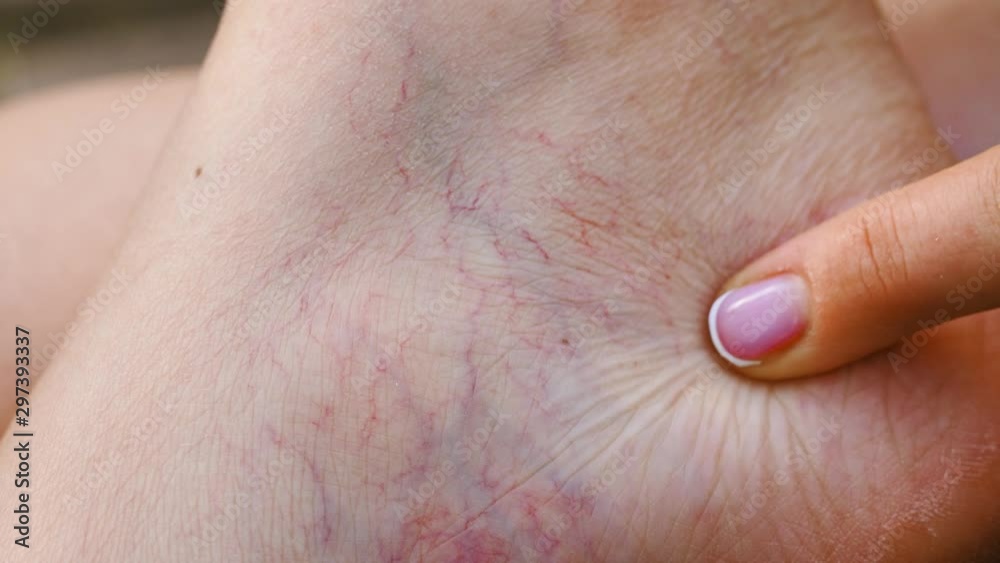 Vascular dilatation of veins on leg Vascular dilatation of veins on leg