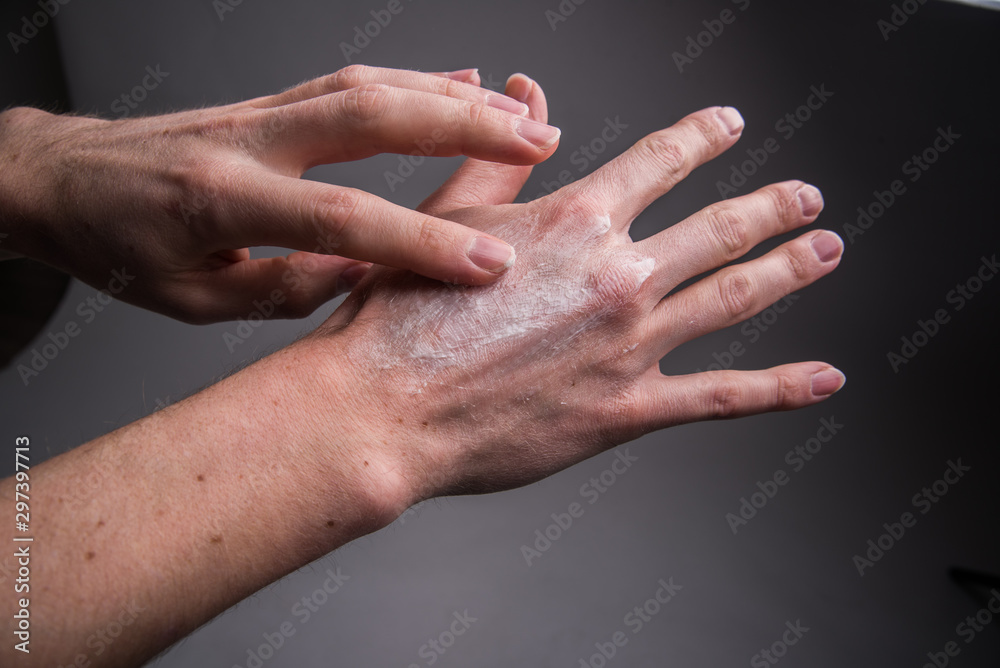 Fototapeta premium apply sunscreen on the hands