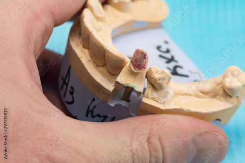 plaster models of the human jaws in the hand of a dental technician in a dental laboratory, manufacturing denture photo