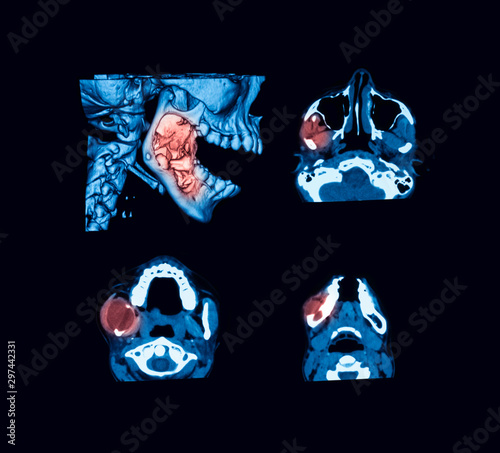 Canvas Print Computed tomography (CT-scan) head, a case of nkeratocystic odontogenic tumour