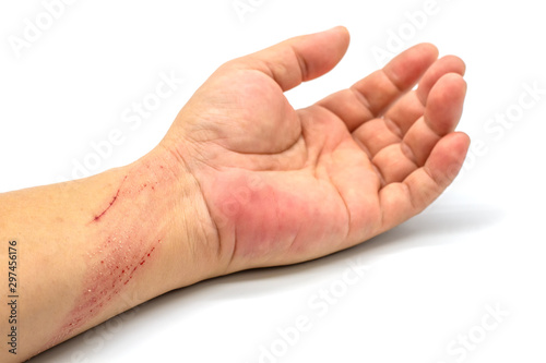Bruised wound injury on arm near wrist on white background.