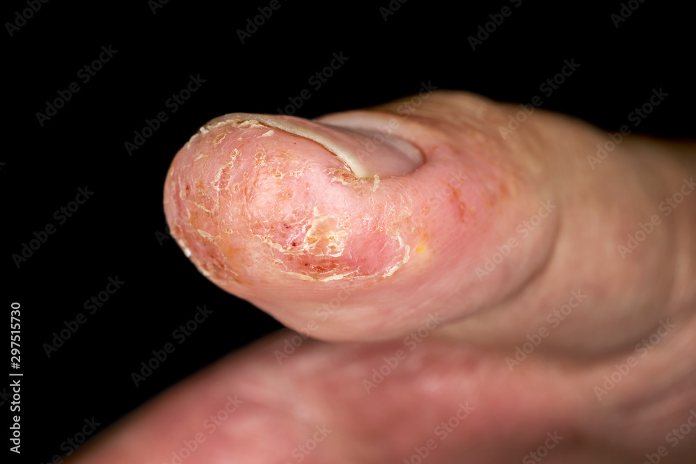 Closeup of eczema dermatitis allergic skin rash on male thumb with skin peeling. . Isolated over black background. Macro. Shallow depth of field. Closeup of eczema dermatitis allergic skin rash on male thumb with skin peeling. . Isolated over black background. Macro. Shallow depth of field.