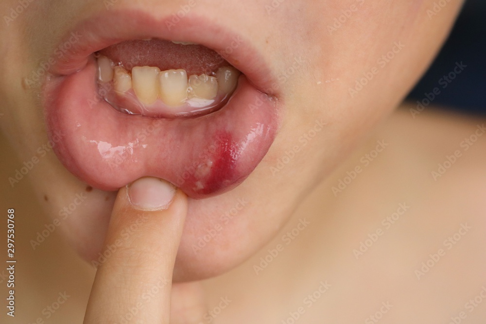 The lip bleeding boy from the bumping accident showing his wound by