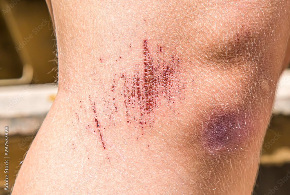 Fototapeta premium Abrasion scratch on the foot close-up