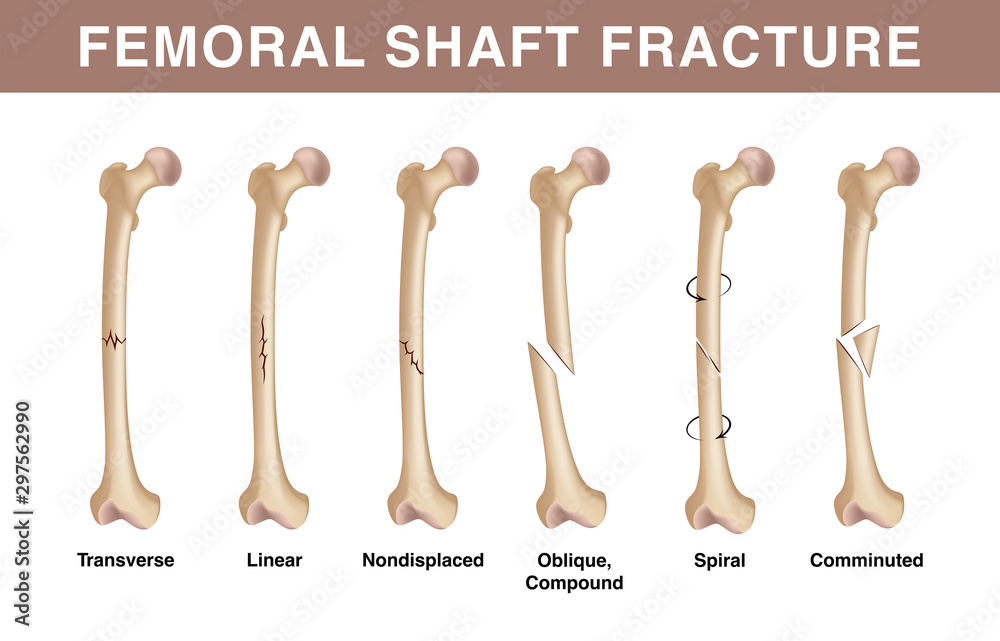 Types of femoral shuft fractures. Realistic drawing showing broken bone