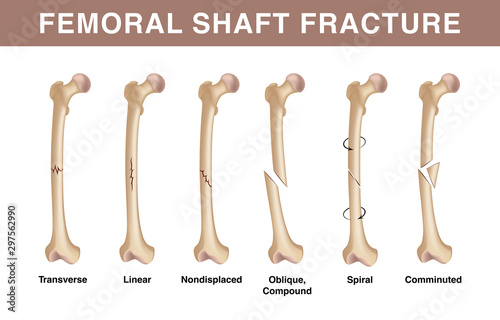 Types of femoral shuft fractures. Realistic drawing showing broken bone with inscriptions isolated on whie background. photo