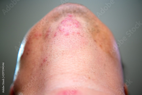 Young men who are sick are herpes zoster at the face and throat