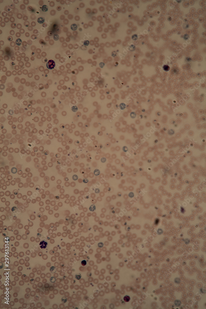 Malariaparasiten in roten Blutkörperchen  unter dem Mikroskop 400x