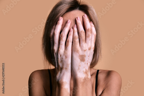 Girl with vitiligo disease covers her face with hands, closeup portrait on beige background photo