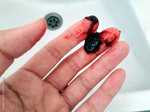 Hand stain Deep red blood clot in hand Symptoms of hemorrhage are life threatening When there is blood flowing out of the body, should seek medical attention to treat.