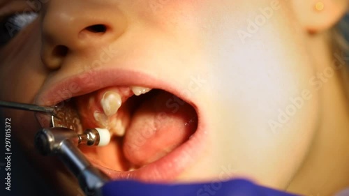 Close-up detail of dentist doctor doing professional cleaning dental plaque and polishing child's teeth at stomatology clinic. Children mouth health hygiene check-up and caries prevention