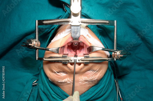 Young patient with cleft lip and cleft palate are treated by surgeons in operating room at the hospital. Children with cleft lip and cleft palate are treated by surgeons.