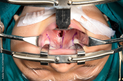 Young patient with cleft lip and cleft palate are treated by surgeons in operating room at the hospital. Children with cleft lip and cleft palate are treated by surgeons.