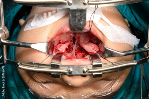 Young patient with cleft lip and cleft palate are treated by surgeons in operating room at the hospital. Children with cleft lip and cleft palate are treated by surgeons.