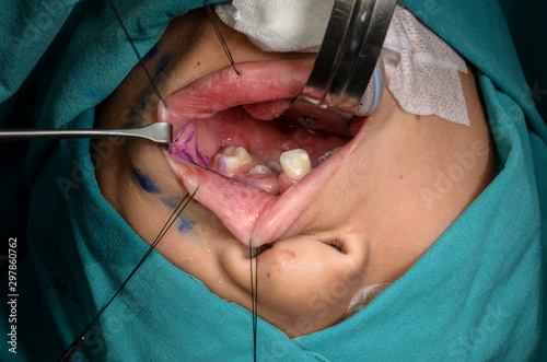 Young patient with cleft lip and cleft palate are treated by surgeons in operating room at the hospital. Children with cleft lip and cleft palate are treated by surgeons.