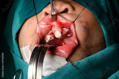Young patient with cleft lip and cleft palate are treated by surgeons in operating room at the hospital. Children with cleft lip and cleft palate are treated by surgeons.