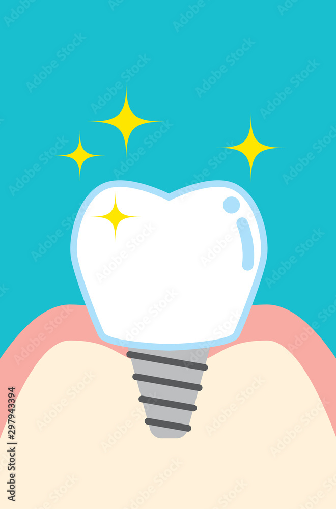 インプラントのかわいい歯のイラスト Cute Cartoon Implant Tooth Stock Vector Adobe Stock