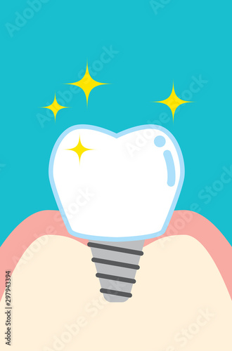 インプラントのかわいい歯のイラスト Cute Cartoon Implant Tooth Stock Vector Adobe Stock インプラントのかわいい歯のイラスト Cute Cartoon Implant Tooth Stock Vector Adobe Stock