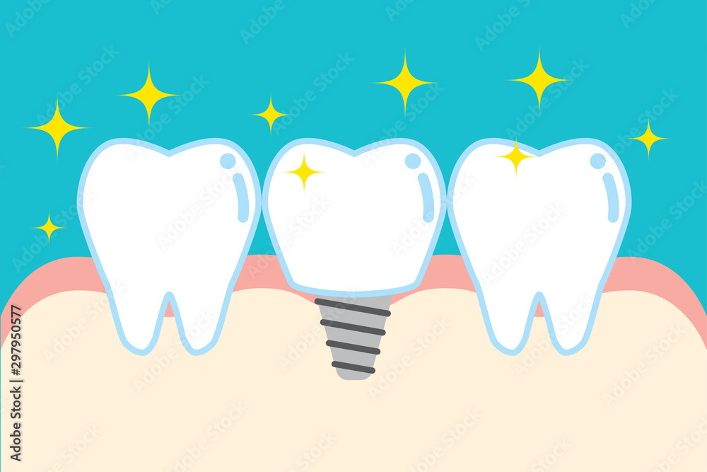 インプラントのかわいい歯のイラスト Cute Cartoon Implant Tooth Illustration Stock Vector Adobe Stock