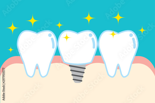 インプラントのかわいい歯のイラスト cute cartoon implant tooth illustration