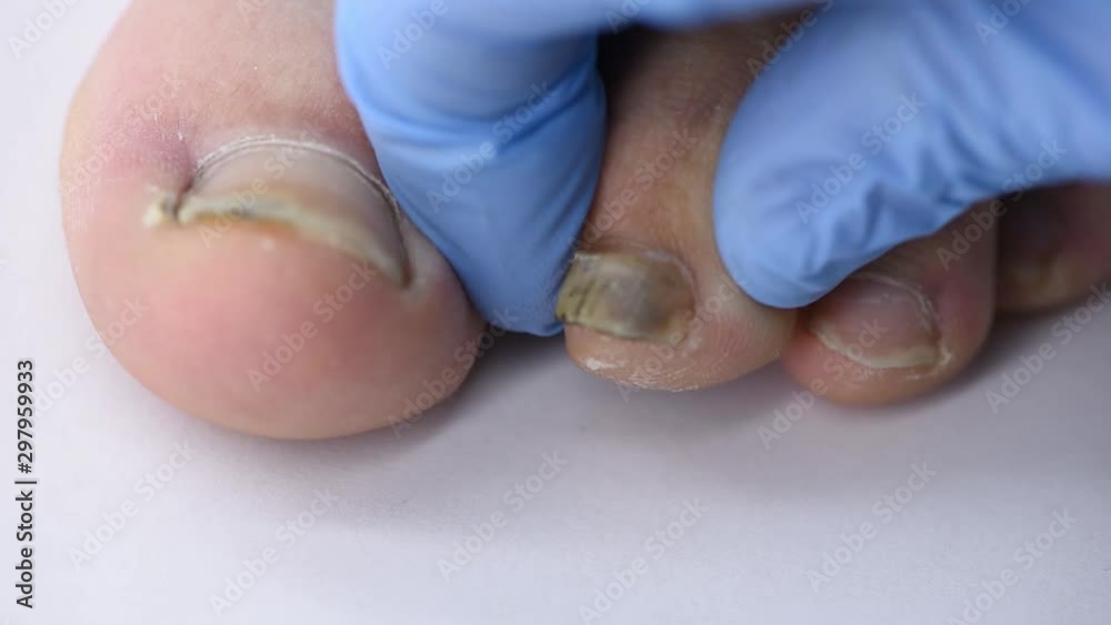 Close-up of doctor's hand examining a deformed nail that comes off a man’s foot Close-up of doctor's hand examining a deformed nail that comes off a man’s foot
