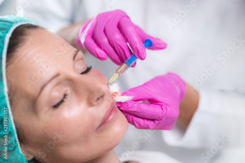 Hyaluronic Acid Injection Fillers for Cheeks