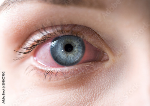 Macro of red woman eye. Bloodshot eye - conjunctivitis or allergic reaction. photo