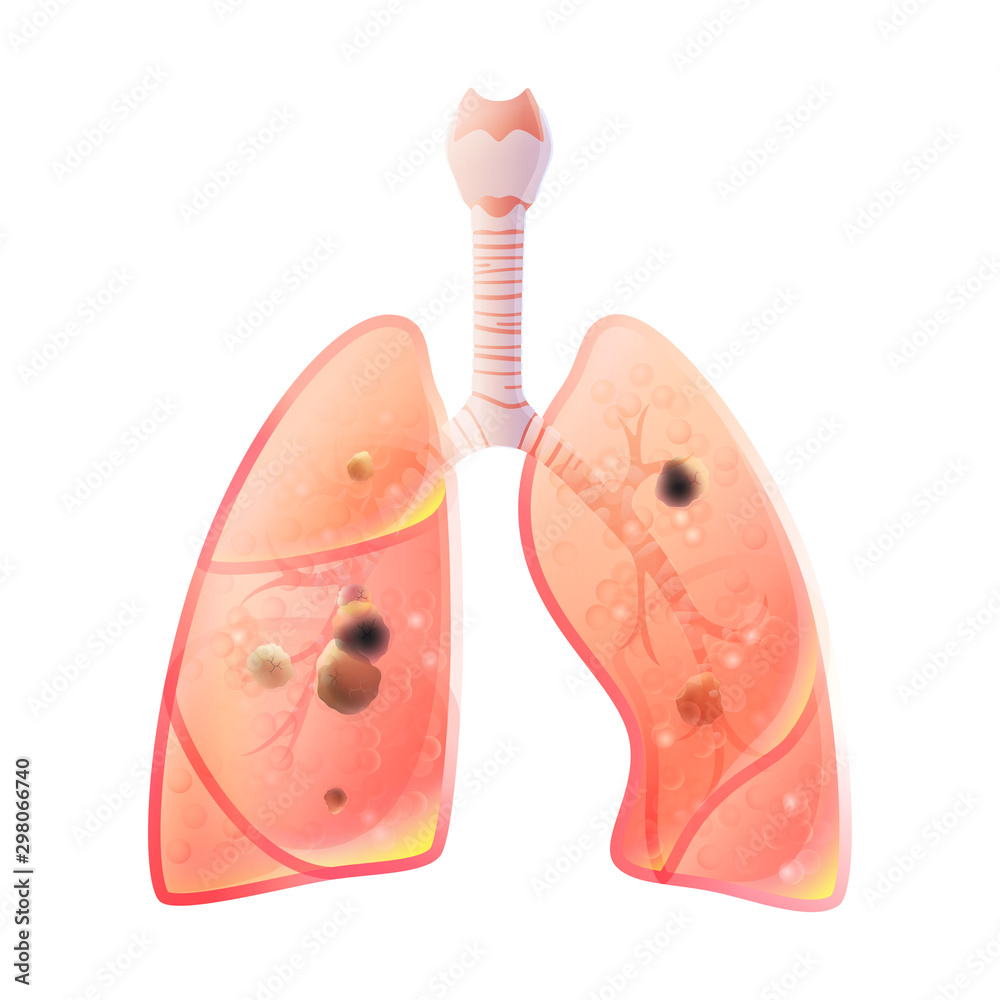 Vector illustration of lung cancer Vector illustration of lung cancer