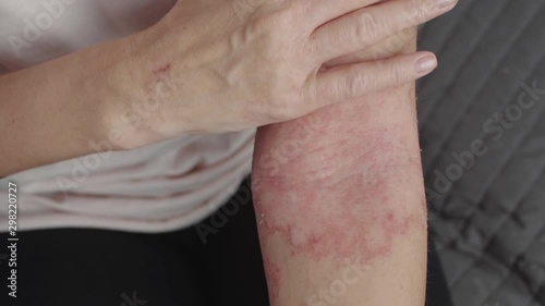 allergic dermatitis on the arms photo