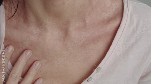 dermatitis on the skin of the neck photo