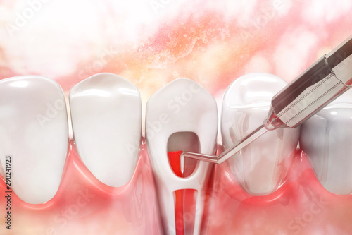 Foto Root canal treatment process