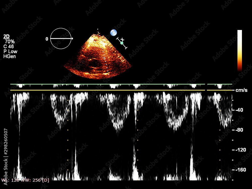 Screen of echocardiography (ultrasound) machine. Stock Photo | Adobe Stock
