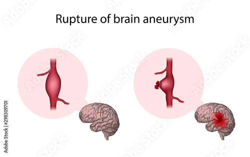 Brain aneurysm, reptured. Cerebral hemorrhage, bleeding. Medical anatomy illustration.