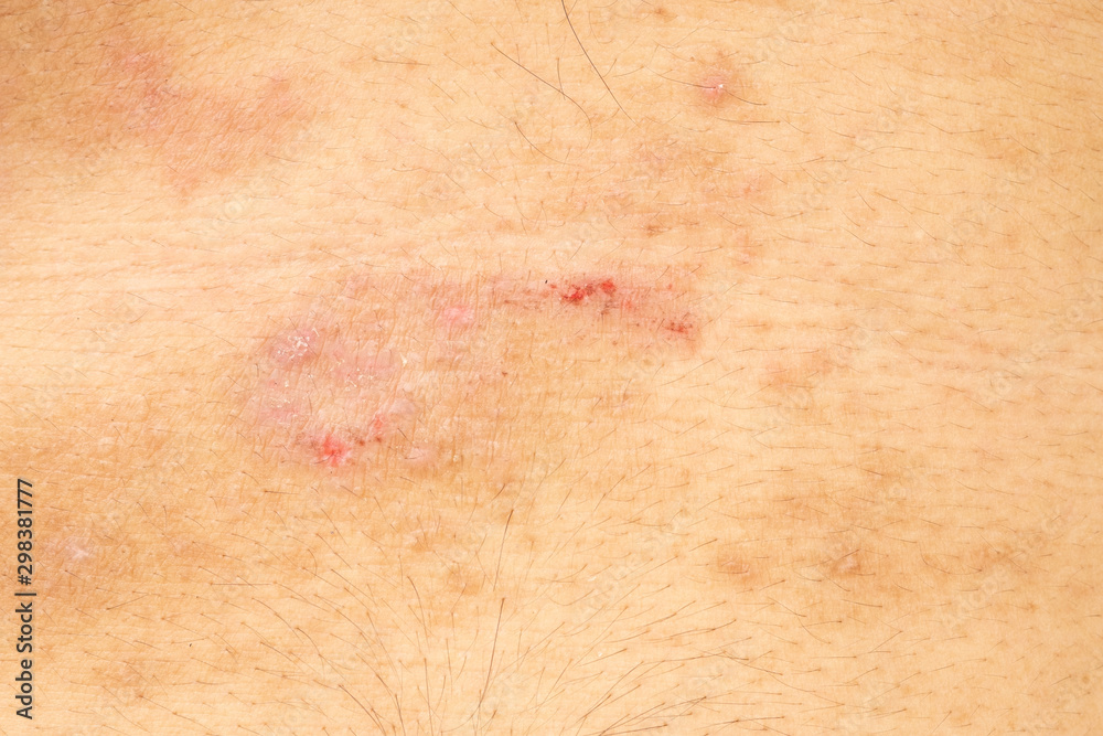 Closeup image of a male body suffering from chronic skin rash. Food allergy rash. Closeup image of a male body suffering from chronic skin rash. Food allergy rash.