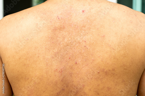 Closeup image of a male body suffering from chronic skin rash. Food allergy rash.