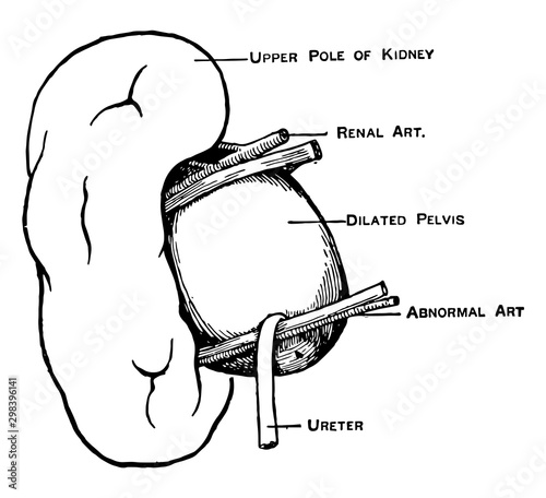 Abnormal Renal Artery, vintage illustration.