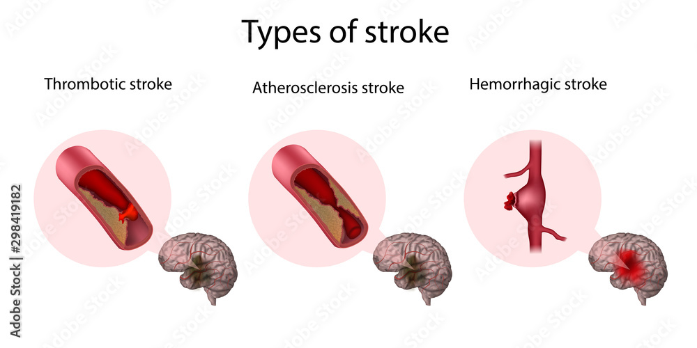 Types of stroke. Thrombotic, Atherosclerosis, Hemorrhagic stroke