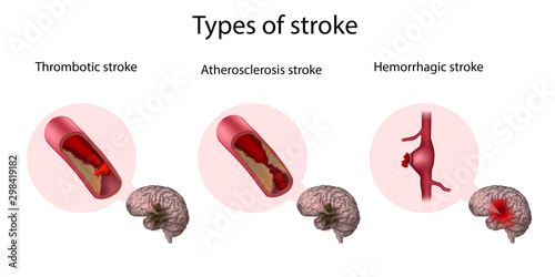 Types of stroke. Thrombotic, Atherosclerosis, Hemorrhagic stroke. Medical illustration. photo