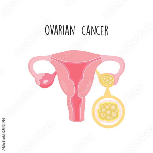 Ovarian Cancer flat vector illustration.