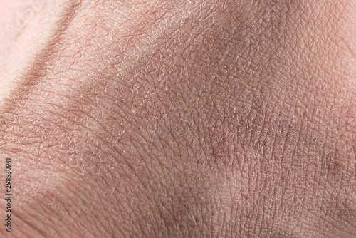 dry skin close-up on a light background, Allergy, skin peeling, moisturizing