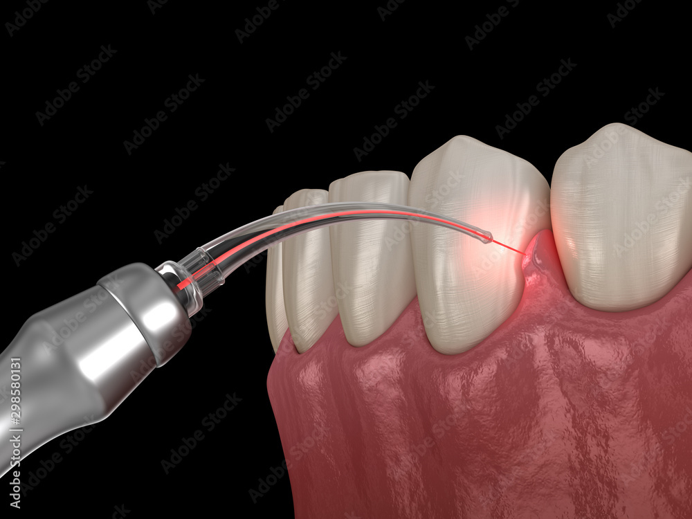 Gum correction surgery with laser.  Medically accurate tooth 3D illustration - obrazy, fototapety, plakaty 