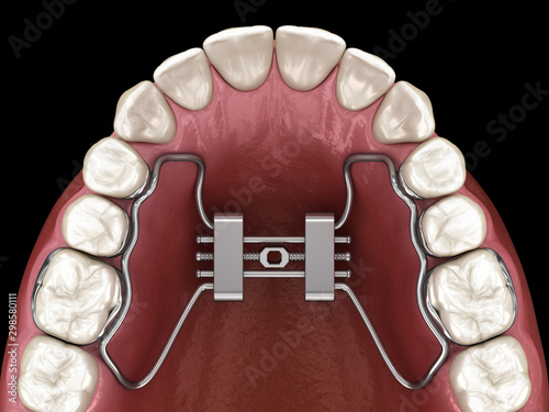 фотографія Rapid Palatal Expansion. Medically accurate tooth 3D illustration