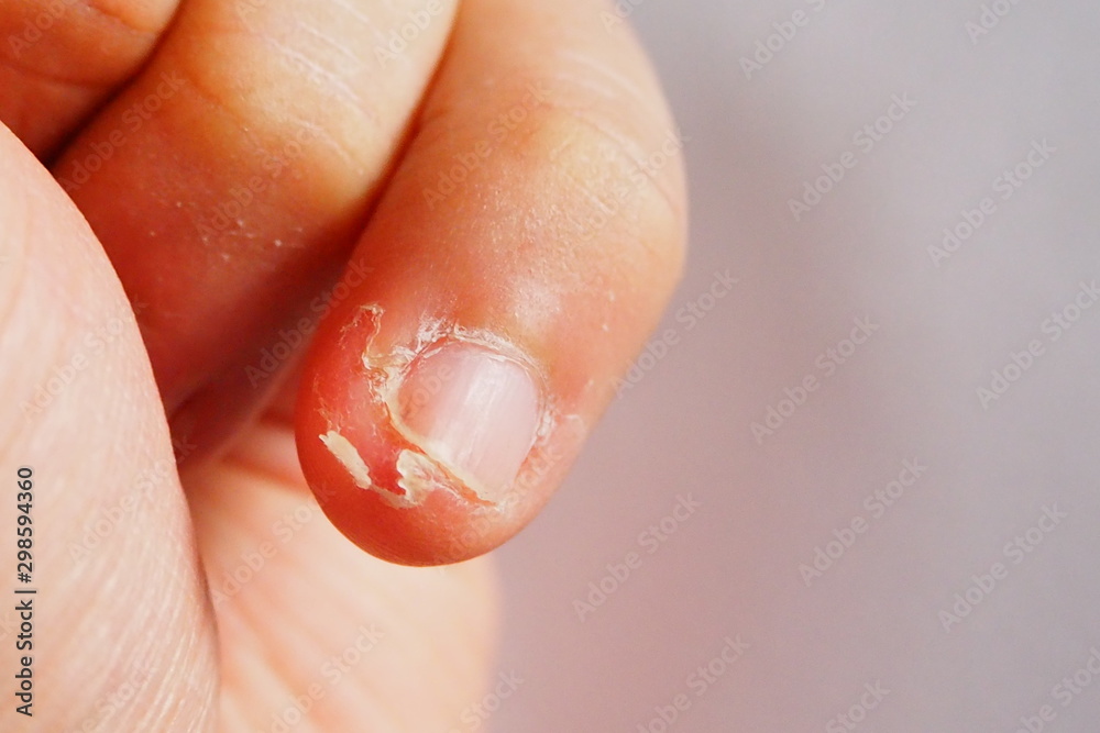 Closeup of irritated skin peeling on fingertips due to direct damage to the skin such as infection of nail biting habit or dryness, itching and chemical contact. Health and medical concept Stock Closeup of irritated skin peeling on fingertips due to direct damage to the skin such as infection of nail biting habit or dryness, itching and chemical contact. Health and medical concept Stock