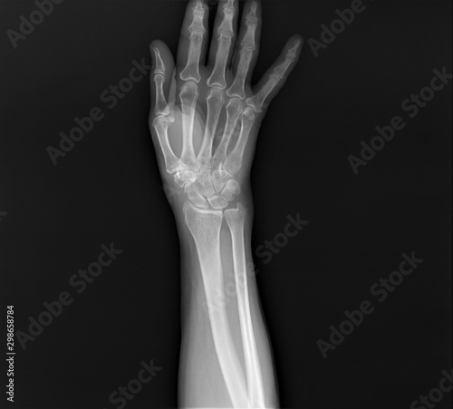 normal radiography of hand and wrist bones, traumatology and orthopedics, traumatology, sports injury