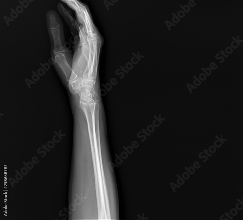 normal radiography of hand and wrist bones  traumatology and orthopedics  traumatology  sports injury