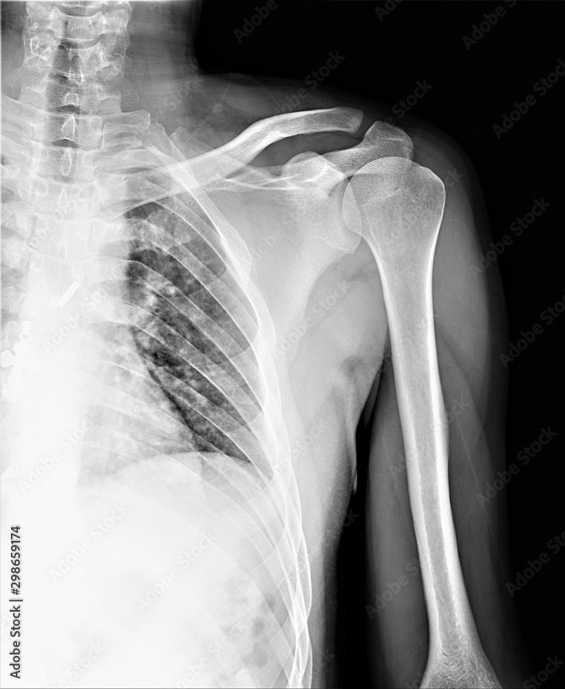 normal radiography of the shoulder joint in direct projection