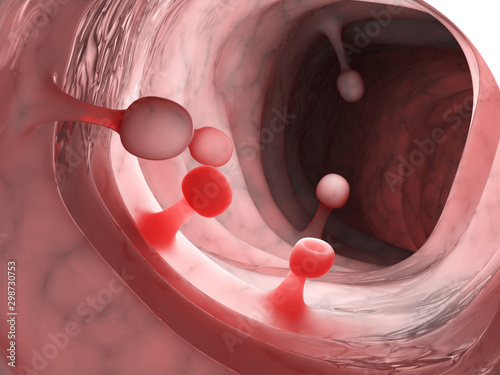 Konstfotografi 3d rendered medically accurate illustration of colon polyps