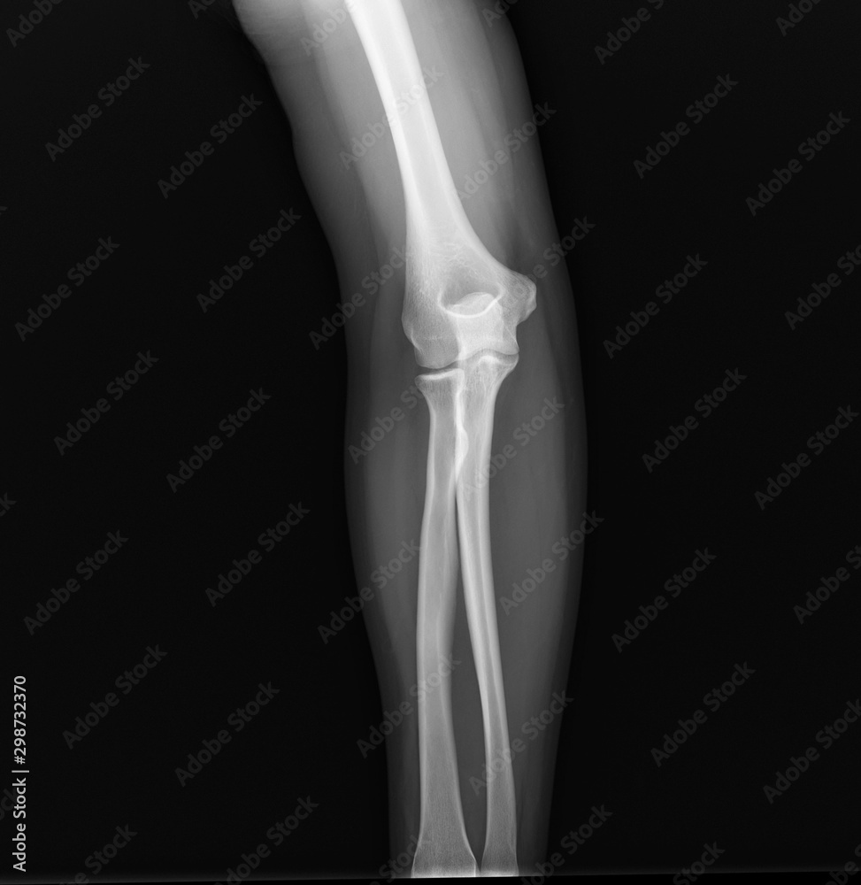 x-ray of the normal elbow joint. traumatology and orthopedics, medical diagnostics, rheumatology x-ray of the normal elbow joint. traumatology and orthopedics, medical diagnostics, rheumatology